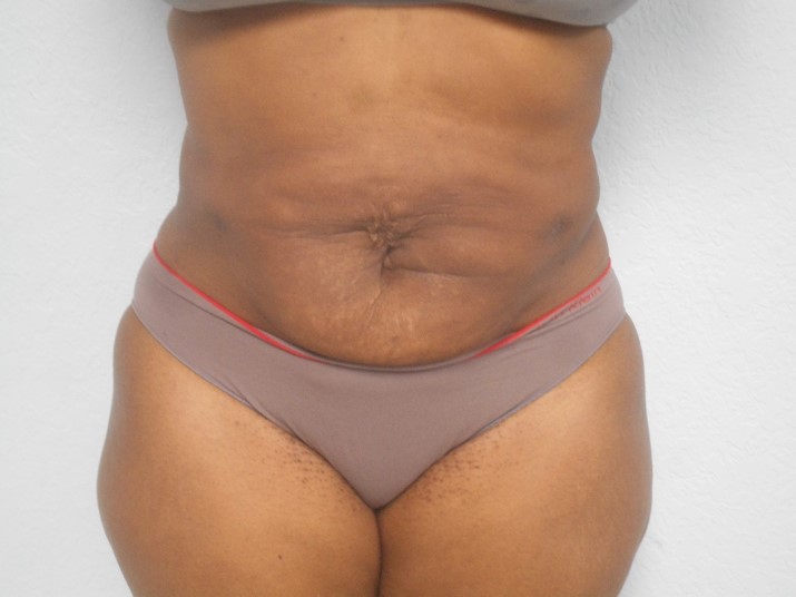 Liposuction patient after