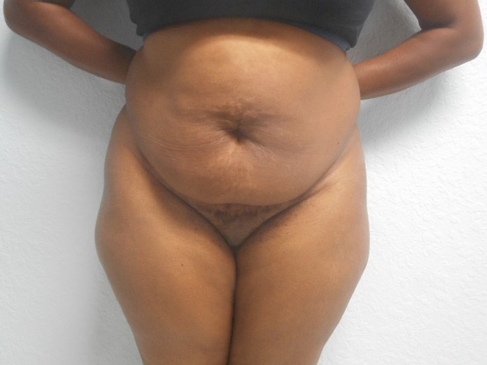 liposuction patient before