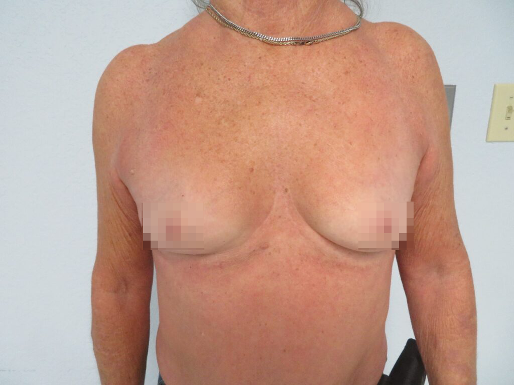 female patient before surgery