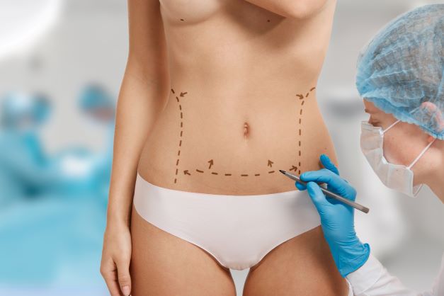 woman marked out cosmetic surgery